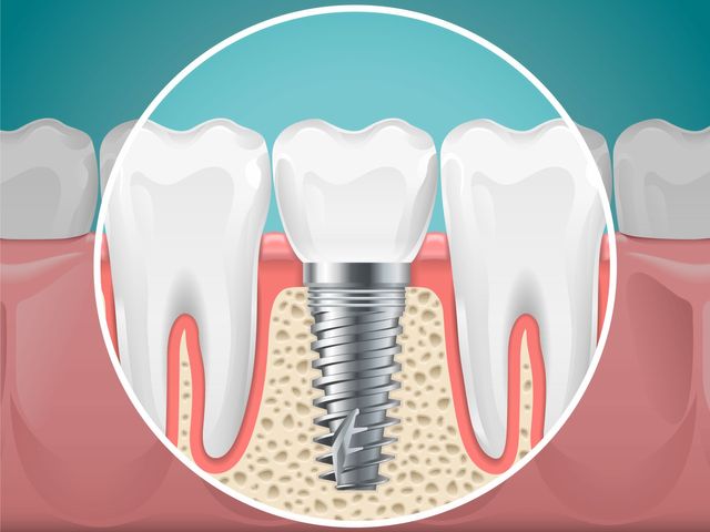 Dental Implants Washington DC - Cost of Dental Implants - DC Dental Spa