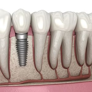 a 3D illustration of a dental implant