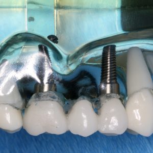 A bridge of teeth can be supported by two or more implants.